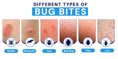 Bites cause muscle pain and spasms in the arms, legs, abdomen, and back. . Nerve pain feels like bug bite